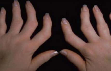 'eklemlerde Ağrı Ve Şişliğe Dikkat'