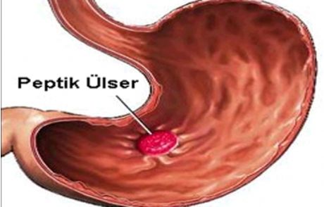 Ülser Hakkında Herşey!