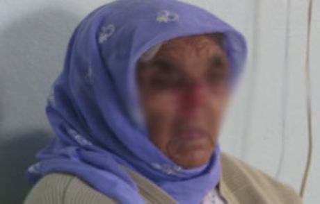 Bir Sivilce Yüzünden Burnunu Kaybetti