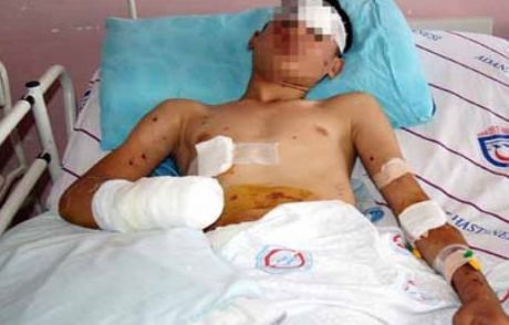 Polise Atmak İstediği Bomba Kolunu Kopardı