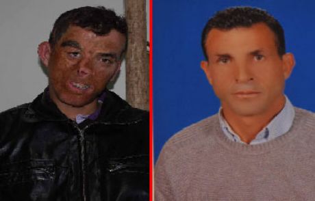 Türkiye'de İlk Yüz Nakli Gerçekleştirildi