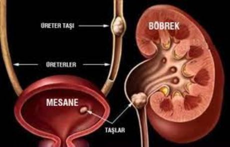Böbrek Taşı Nasıl Tedavi Edilir?