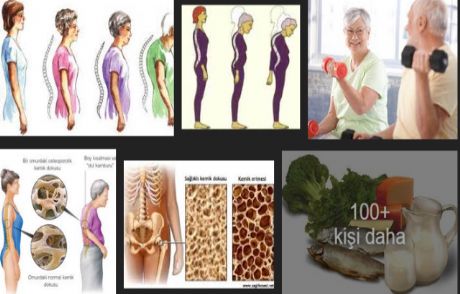 Osteoporoz Hastaları Böbrek Taşına Dikkat!