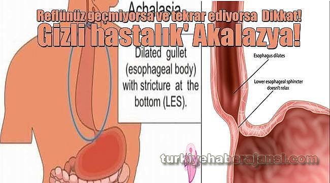 Gizli Hastalık Akalazyaya Dikkat!