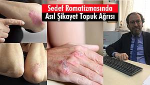 Sedef Romatizmasında Asıl Şikayet Topuk Ağrısı
