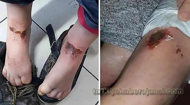 Kar Yanığı Denmişti! Asıl Nedeni Belli Oldu!