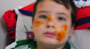 Köpeğin Isırdığı 8 yaşındaki Mert'in Yüzüne 60 Dikiş Atıldı