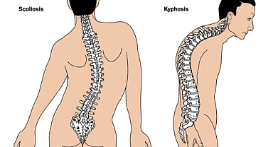 Yeni Kuşakta Gizli Tehlike Kamburluk (KİFOZ)